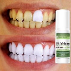 Natural Remove Stain Yellow Teeth White Tooth Cleaning Oral Mouth Spray 60ml Feature: Removes stains and whitens your teeth while you brush. Gel penetrates the enamel pores to help lift and remove stains. Experience a long-lasting whiter smile when using gel as directed. You can always count on a whiter smile when using Remove the stains resulted from and drinking tea. The excellent and cool mint taste could ozostomia. Ensure your healthy and confident smile. No strips, no uncomfortable lights, Natural Teeth Whitening Diy, Dental Bleaching, Denture Cleaner, Mouth Spray, Teeth Whitening Homemade, Tooth Cleaning, Teeth Whitening Remedies, Teeth Whitening Diy, Teeth Whitening Gel