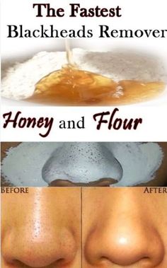 The Fastest Blackheads Remover with Honey and Flour - How to Get Rid of Blackheads – 15 Blackhead Removal DIYs to Clean Your Skin Naturally #NaturalRemediesForAnxiety Covering Acne, Skin Moles, Black Heads, Clear Skin Tips, Acne Remedies, How To Get Rid Of Acne, Skin Care Solutions, Skin Care Recipes, Diy Skin Care