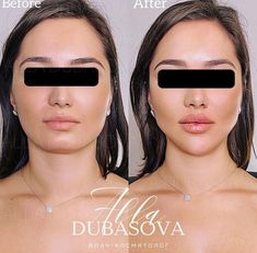 Face Contouring Surgery, Chin Fillers Before After Round Face, Facial Contouring Fillers, Cheekbone Filler, Cheekbone Filler Before And After, Face Contouring Fillers, Masseter Botox Before And After