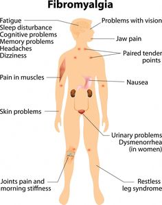 Are you experiencing brain fog, strange tingling and body aches? These may be signs of fibromyalgia. Read to learn more about this condition. Musculoskeletal Pain, Jaw Pain, Restless Leg Syndrome, Memory Problems, Alternative Treatments, Chronic Condition, Acupressure, Chronic Pain, Headache