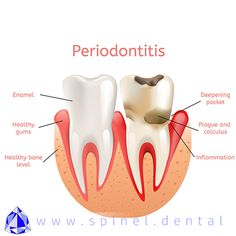 Bleeding gums  Loose teeth  New spacing between teeth  Persistent bad breath Pus around the teeth and gums Receding gums Red and puffy gums Tenderness or Discomfort Gums Receding, Healing Cavities, Teeth Poster, Loose Teeth, Oral Pathology, Health Chart, Gum Recession, Dental Hospital, Loose Tooth