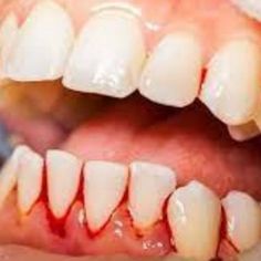 Popular toothpaste rotting away your gums and teeth-Fix Receding Gums and Tooth Decay - Bestoralcareadvice - Medium Teeth Whitening At Home, Reverse Cavities, Dental Decay, Tooth Repair, Teeth Whitening Remedies, Teeth Whitening Diy, Grills Teeth