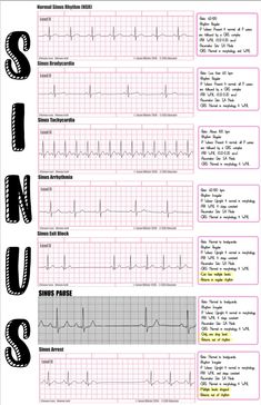 EKG Need to Knows/ Nursing/ EMT Paramedic/ Cardiology - Etsy Paramedic Cardiology, Ekg Interpretation Made Easy, Emt Study, Ekg Interpretation, Paramedic School, Nursing School Essential, Nurse Study Notes, Basic Anatomy And Physiology, Nursing Student Tips