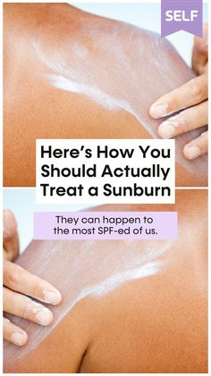 With summer approaching, we're breaking down proper sunburn relief and sunburn remedies. Best Remedy For Sunburn, Best Sunburn Relief, Sunburn Face, How To Help Sunburn, How To Treat Sunburn, Burn Remedy, Burn Relief