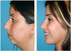 Chin Augmentation