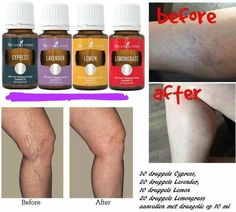 Varicose Veins Essential Oils, Young Living Oils Recipes, Essential Oil Roller Bottle Recipes, Essential Oil Remedy