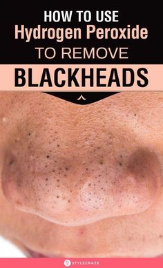 Hydrogen peroxide is the universal go-to ingredient when it comes to skincare. Read this article to how to use hydrogen peroxide to remove blackheads safely. Hydrogen Peroxide Uses, Clothes Hacks, Skin Natural Remedies, Cold Sores Remedies, Natural Sleep Remedies, Natural Cold Remedies