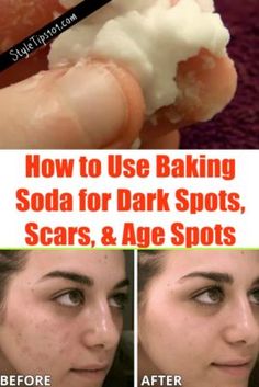 Baking Soda for Dark Spots Sunspots On Face, Blackhead Remover Diy, Brown Age Spots, Baking Soda For Hair, Baking Soda Face, Acne Dark Spots