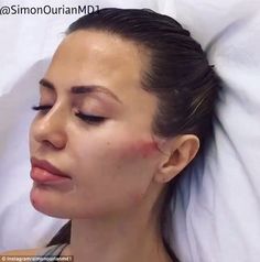 Better than make-up? Cosmetic dermatologist Dr. Simon Ourian has filmed himself giving his patient Victoria Bonya facial contouring, jaw enhancement, a cheek lift, and a chin lift using derma fillers Contouring Jawline, Chin Lift, Facial Injections, Derma Fillers, Cosmetic Fillers, Cheek Lift, Kylie Jenner Lips