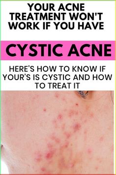 How to get rid of cystic acne?Why won't my acne treatment work? Is my acne even cystic? It can be hard to manage acne but knowing which ingredients can truly benefit your skin is key. Read more to find out why your acne treatments are not working and how to finally get clear skin Cystic Acne Popping, Acne Popping, Get Rid Of Cystic Acne, Get Clear Skin, Acne Treatments, Essential Oils For Skin, Cystic Acne, Prevent Acne, Oils For Skin