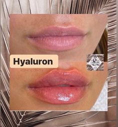 Lip Filler Shape Ideas, Lip Threading, Makeup Tips For Blue Eyes, Russian Lips, Heart Shaped Lips, Lips Inspiration, Face Fillers, Botox Lips, Aesthetic Center