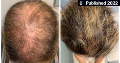 An Old Medicine Grows New Hair for Pennies a Day, Doctors Say (Published 2022) Regrow Thinning Hair, Unwanted Hair Growth, Beta Blockers, Make Hair Grow, Hair Remedies For Growth, Female Hair, Unwanted Hair Removal, Hair Restoration, Unwanted Hair