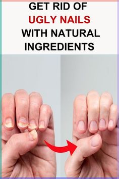 Struggling with toe nail or finger nail fungal infection? Discover effective home remedies using natural ingredients to treat and fix nail fungus. Learn how essential oils, hydrogen peroxide, and other treatments can clear nail fungus and promote nail care. These tips will help you clean toe nails, kill fungus, and prevent future infections. Get ready for effective nail fungus removal and a cure for healthier nails! Find out how to achieve nail fungus removal and enjoy clean toe nails today. Toenail Fungal Infection, Nail Discoloration, Free Nails, Toenail Fungus Remedies, Nail Fungus Remedy, Nail Infection, Fungal Nail, Nails Today, Toenail Fungus