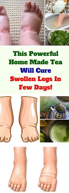 Swollen Feet Remedies, Swollen Ankles, Holistic Health Remedies, Swollen Legs, Reduce Swelling, Juicing Benefits, Health Hacks, Fluid Retention