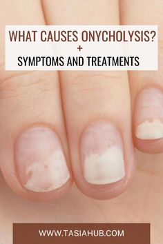 Onycholysis of the nail is a common nail disorder that occurs when the nail plate separates from the nail bed, resulting in a well-defined area of white Nail Health Signs, Nail Disorders, Diseases And Disorders, Nail Ridges, Nail Conditions, Nail Picking, Health Signs