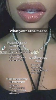 What Different Places Of Acne Mean, Where My Acne Is And What It Means, How To Make Acne Look Good, Why You Have Acne In Certain Spots, What Ur Acne Mean, What Your Acne Mean, Diet To Get Rid Of Acne, Pimple Area Meaning, What Different Acne Spots Mean