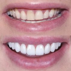 Grow Back Receding Gums, Whiten Teeth Fast, I Healed, Teeth Design, Tooth Decay Remedies, Bad Teeth, Laser Surgery