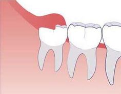 Wisdom Teeth Removal Necessary Wisdom Teeth Pain Relief, Wisdom Teeth Pain, Tooth Pain Relief, Dental Implants Cost, Wisdom Teeth Removal