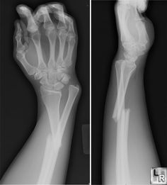 an x - ray image of the right hand and left arm