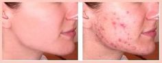 Cystic acne is an advanced and often times painful type of acne that many teenagers and adults can suffer from. I’ll show you how I cured my cystic acne in 30 days and how you can too! You get a pimple when a pore in your skin gets clogged, usually with dead skin cells. Sometimes… Read More » Chin Acne Remedies, Cystic Acne On Chin, Korean Beauty Secrets, Skin Cleanser, Types Of Acne, Acne Scar Removal