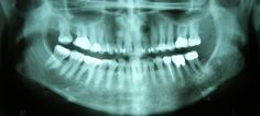 teeth x ray Teeth Repair, Tooth Repair, Dental Insurance Plans, Tooth Replacement, Missing Teeth, Dental Insurance, Mind Body Connection, Blog Website, Stay Healthy