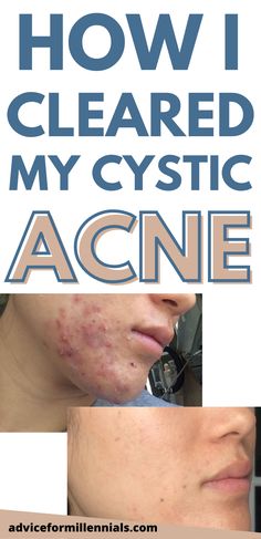 Acne Causes