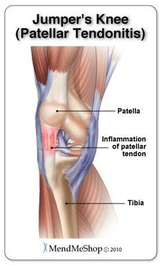 The knee has 2 collateral (parallel) ligaments and 2 cruciate (crossing) ligaments. The medial collateral ligament (MCL) and the lateral collateral ligament (LCL) provide support to the knee by limiting the sideways motion of the joint. The anterior cruciate ligament (ACL) and the posterior cruciate ligament (PCL) stabilize the knee by limiting the rotation and the forward and backward movement of the joint. Common Knee Injuries, Knee Ligament Injury, Jumpers Knee, Knee Ligaments, Runners Knee