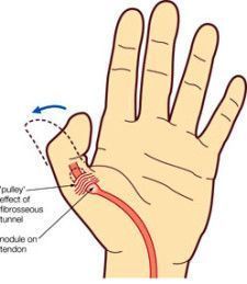 Finger Splint