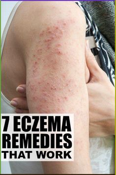 From environmental factors to diet and cream recommendations, these eczema remedies will help keep your eczema under control and prevent future flare ups. Home Remedies For Warts, Warts Remedy, Environmental Factors, Skin Remedies, Lose 40 Pounds, Yoga Sequences, Health Remedies, Home Remedies, Health Benefits