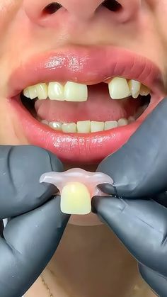 Clear Retainers, Denture Adhesive, Dental Videos, Dental Implants Cost, Dental Anatomy, Partial Dentures, Teeth Whitening Diy, Medical Animation