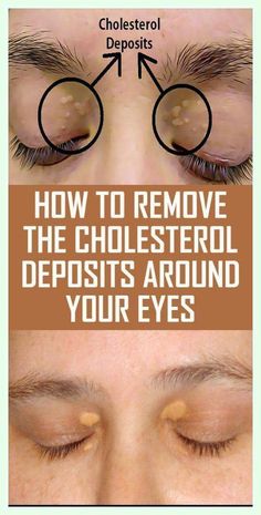 Cholesterol Deposits by Fiona Grant | This newsletter was created with Smore, an online tool for creating beautiful newsletters for educators, businesses and more Remove Skin Tags Naturally, Natural Cough Remedies, Medical Terms, Cold Sore, Acne Remedies, Lose 40 Pounds, Skin Care Treatments, Natural Medicine, Healthier You