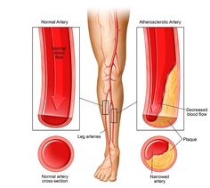 Peripheral Arterial Disease Comparison Illustration Comparison Illustration, Peripheral Artery, Gastrocnemius Muscle, Vascular Ultrasound, Calf Cramps, Leg Veins, Aching Legs, Support Socks, Leg Cramps