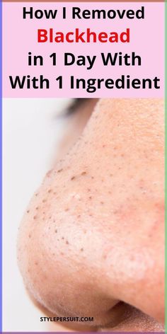 You can easily get rid of these blackheads by using natural or home remedies for blackhead treatment. Click to read How to get rid of blackheads diy| The best blackheads removal on nose| get rid of blackhads on face| get rid of blackheads on nose| how to get rid of blackheads naturally What Are Blackheads, Remove Blackheads From Nose, Blackhead Remover Diy, Blackhead Remedies, Blackheads On Nose, Rid Of Blackheads, Blackhead Mask, Homemade Scrub, Blackheads Removal