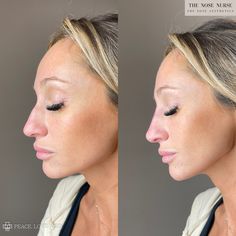 Tinkerbell Nose Filler, Nose Job Thick Skin, Nose Filler, Nose Job Tip Reduction, Nose Filler Before After Non Surgical, Non Surgical Nose Job, Nose Fillers, Thick Skin Bulbous Tip Rhinoplasty