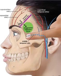 Face Injections, Restylane Lyft, Skin Anatomy, Face Fillers, Botox Lips, Aesthetic Dermatology, Facial Anatomy, Botox Cosmetic, Botox Face