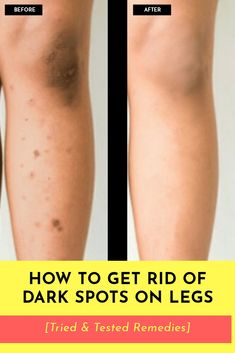 Leg Scars, Dark Spots On Legs, Spots On Legs, Dark Spots On Face, Smooth Legs, Dark Spots On Skin, Skin Spots, Spots On Face, Beauty Tips For Glowing Skin