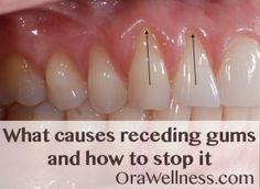 What causes receding gums and how to stop it - OraWellness Gum Recession, Stronger Teeth, Receding Gums, Gum Care