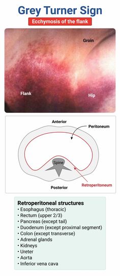 the diagram shows how to get rid from an ectomticic and what it looks like