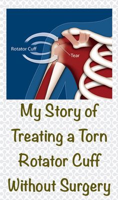 I discovered that treatment doesn't always require surgery. This article is a review of how I avoided surgery. Torn Rotator Cuff Exercises, Supraspinatus Tendon Tear, Meniscus Surgery Recovery, Shoulder Injury Exercises, Rotator Cuff Injury Exercises, Torn Rotator Cuff, Shoulder Muscle Pain