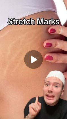 Matt Randon 🧩 on Instagram: "HOW TO GET RID OF STRETCH MARKS!😱 (follow for more!💗)

@muradskincare partnet. This cream contains retinal which is amazing for antiaging and treating stretch marks, cellulite and crepey skin.

#stretchmarks #bodycream #bodycare #cellulite #skincarereview #skincarejunkie #skincareroutines #skincareregime"