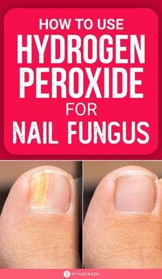 3 days Foot Soak Recipe, Tongue Health, Home Health Remedies, Toenail Fungus, Nail Fungus, Nail Health, Hydrogen Peroxide, Natural Health Remedies