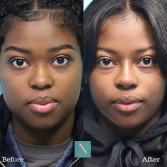 Rhinoplasty Before And After Black Women, Small Nose Tip, Lower Blephoraplasty Before And After, Rhinoplasty Before After, Feminine Goals, Kpop Plastic Surgery