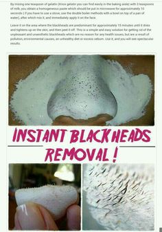 Blackhead Remover Diy, Remove Blackheads, Clear Skin Tips, Homemade Face, Smokey Eyes, Skin Care Solutions, Diy Skin Care