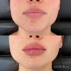 Lip Fillers Round, Heavy Lower Lip Filler, Lips Botox Natural, Round Lip Filler, Lips Injections Shapes, Lip Inspo Filler, Round Lips Filler, Perfect Lips Natural, Full Lips Natural