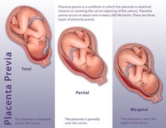 Placenta previa: Total, Partial, Marginal Maternal Newborn Nursing, Pregnancy Anatomy, Newborn Nursing, Nursing Classes, Medical Diagnosis, Nursing Study Guide