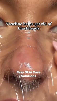 Back Acne Remedies, Glowup Tips, Easy Skin Care, Skin Care Hacks, Blind Pimple, Acne Overnight, Skincare Hacks, Cold Sores, Cold Sores Remedies