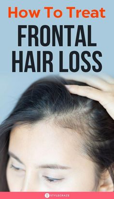 Frontal hair loss or receding hairline is the earliest sign of hair loss. This article discusses what causes it and how to slow down the process of hair loss. Frontal Hair, Front Hair, Hair Remedies, Hair Maintenance, Promotes Hair Growth, Balayage