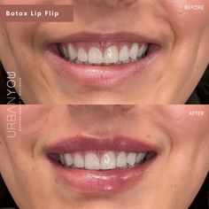 Botox Lip Flip | Before and After Face Injections, Lemon Face Mask, Skincare Products Photography, Lip Filler