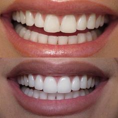 Pizza Waffles, Perfect Smile Teeth, Teeth Veneers, Natural Teeth Whitening Remedies, Veneers Teeth, Teeth Whitening Remedies, Beautiful Teeth, Laser Teeth Whitening, Teeth Whitening System