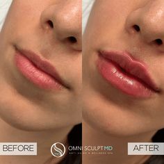 Lip Injection Before & After Gallery | OMNI SCULPT MD Lips Before And After Injections, Juvederm Before And After Lips, Juvederm Before And After, Lip Shading, Botox Filler, Lip Combos, Botox Fillers